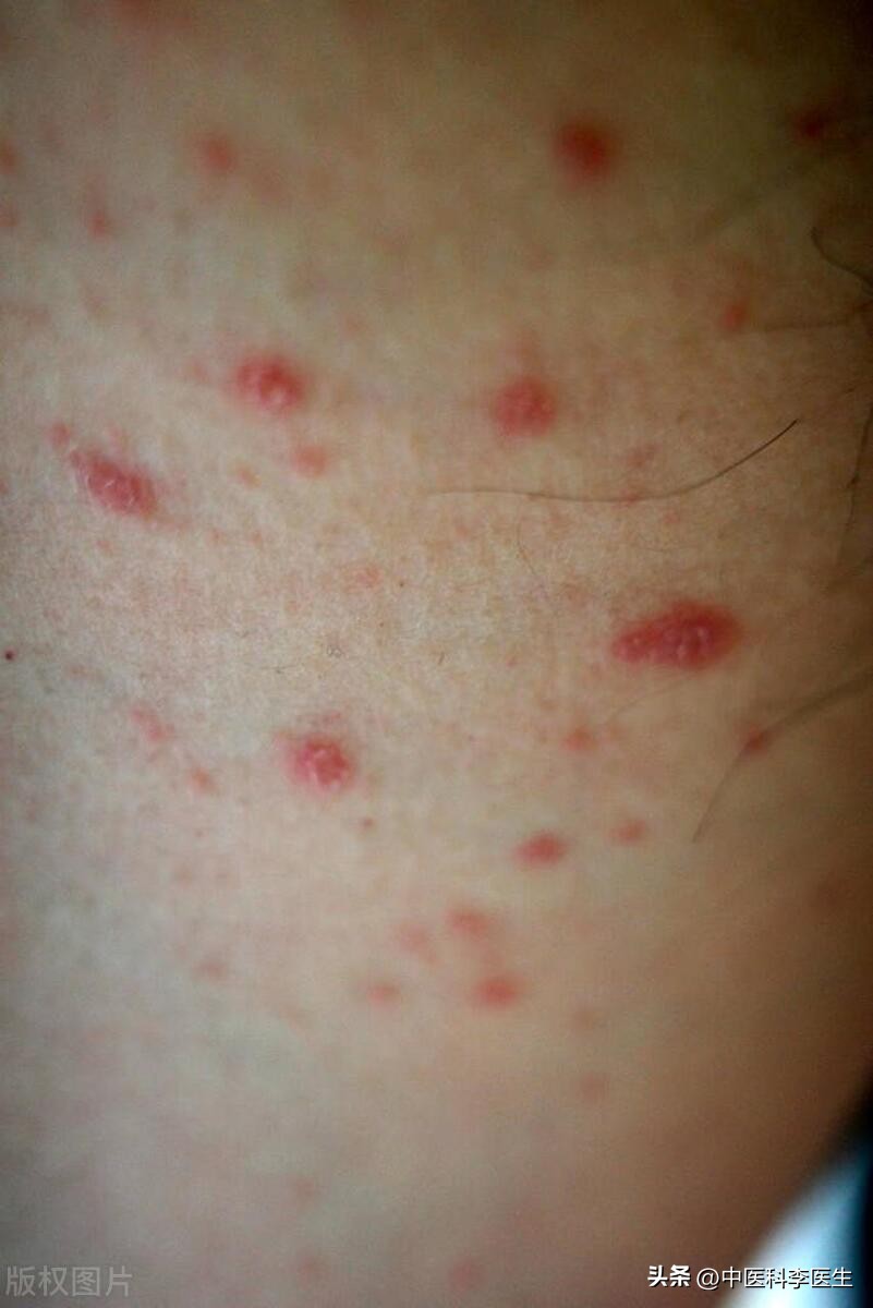 下体瘙痒发现两三只阴虱严重吗,阴部有几十只阴虱