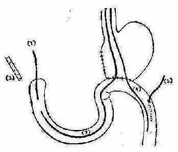 医考知识点总结：十二指肠残端破裂。