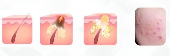 痘痘反反复复挤不干净,痘痘反反复复教你正确处理