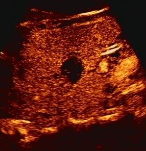 腹部彩超能查出什么病,腹部彩超能查出什么癌症吗