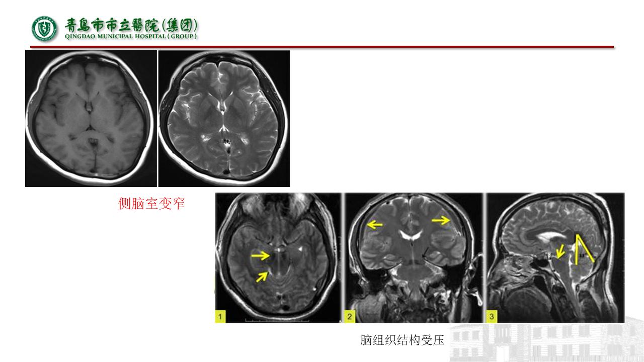 低颅压综合征耳闷,低颅压综合征吃什么药