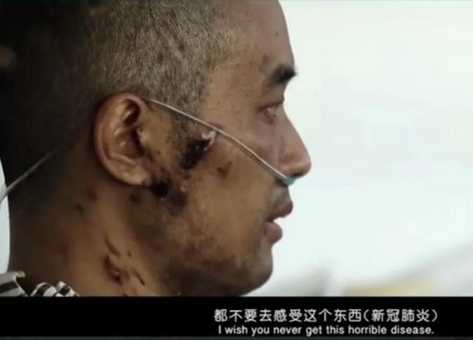 第一批新冠幸存者的故事,新冠第一批幸存者后遗症