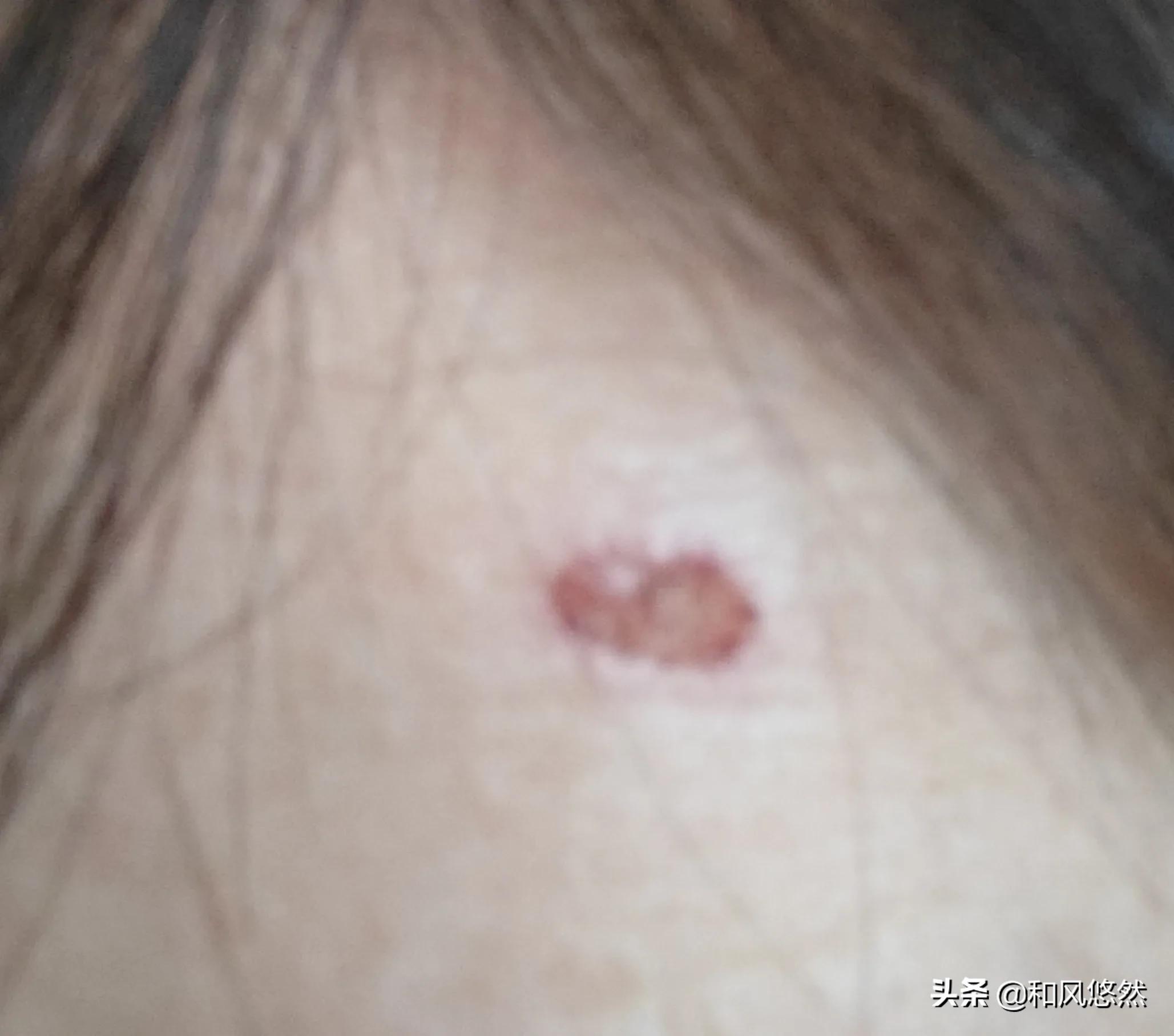 祛斑真实有效推荐,快速祛斑易出现哪些副作用