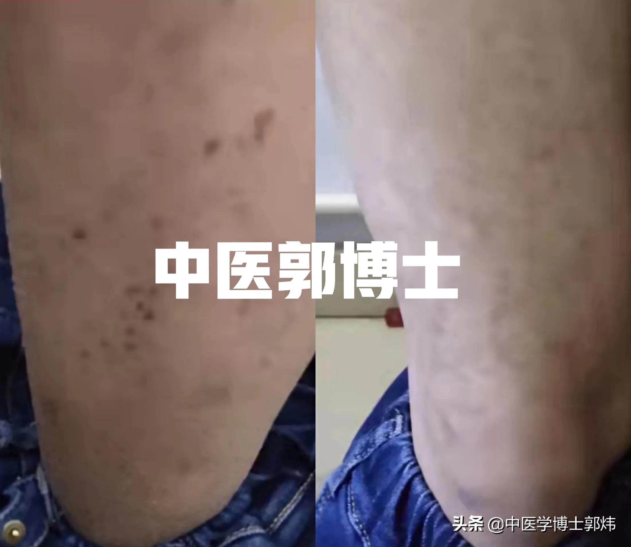 经方治疗色素性紫癜,紫癜中药可以治好吗