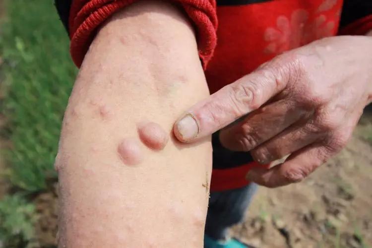 纤维瘤是什么原因造成的怎么治,儿童纤维瘤是什么原因引起的