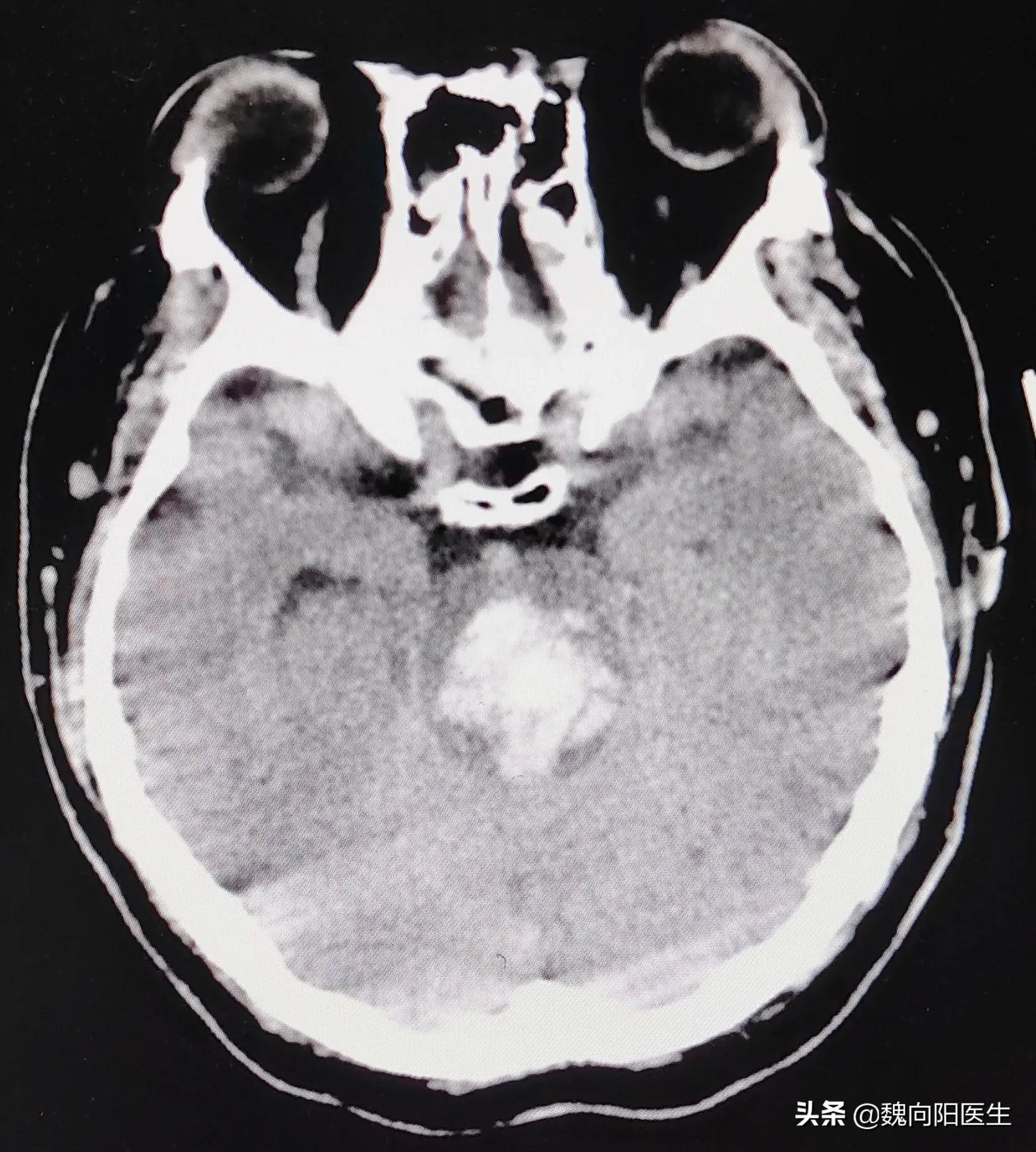 脑干出血患者最好结局,脑干出血留下后遗症恢复的过程