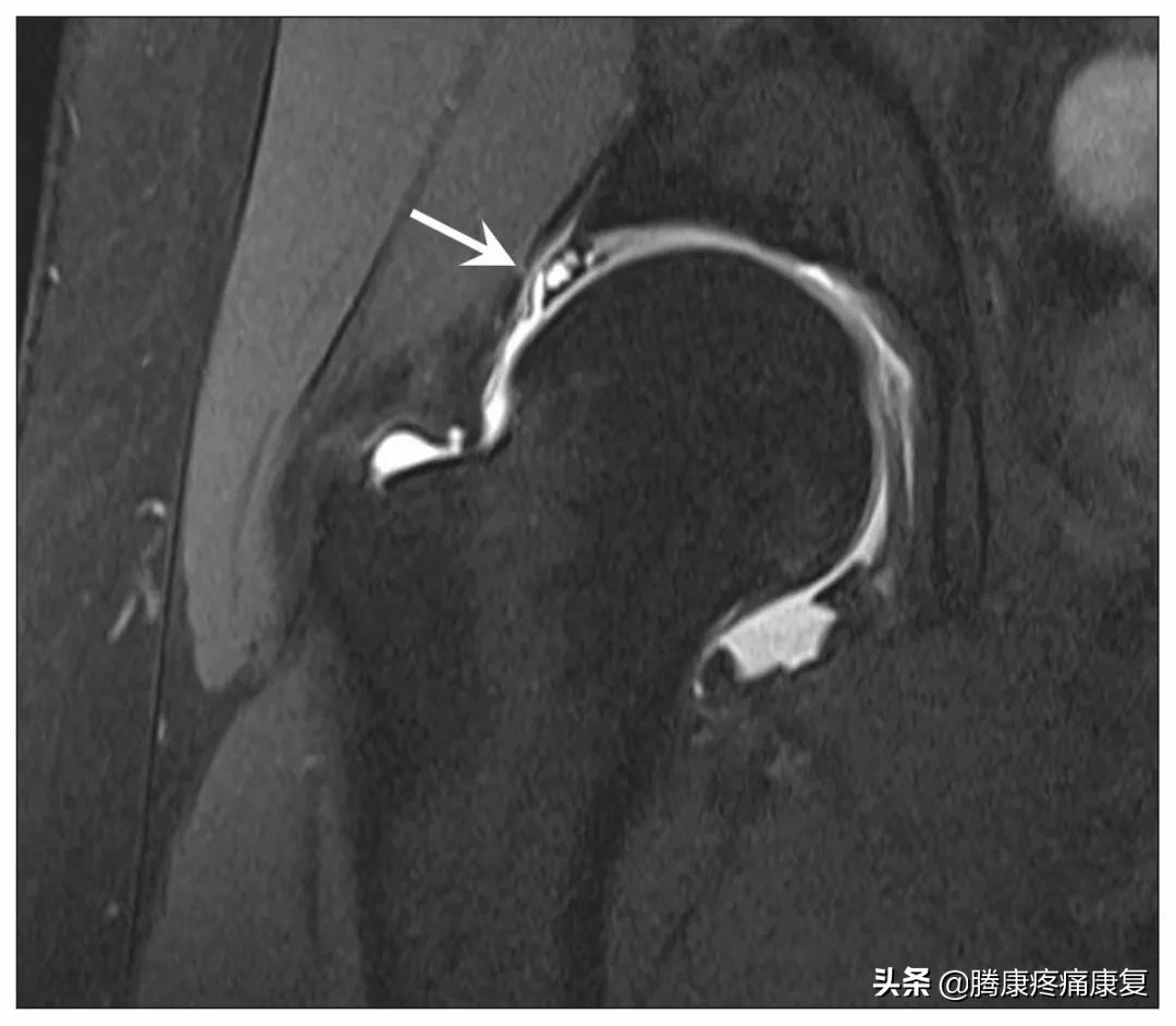 肩袖肌群损伤肩部有什么感觉,肩膀肩袖损伤的康复训练