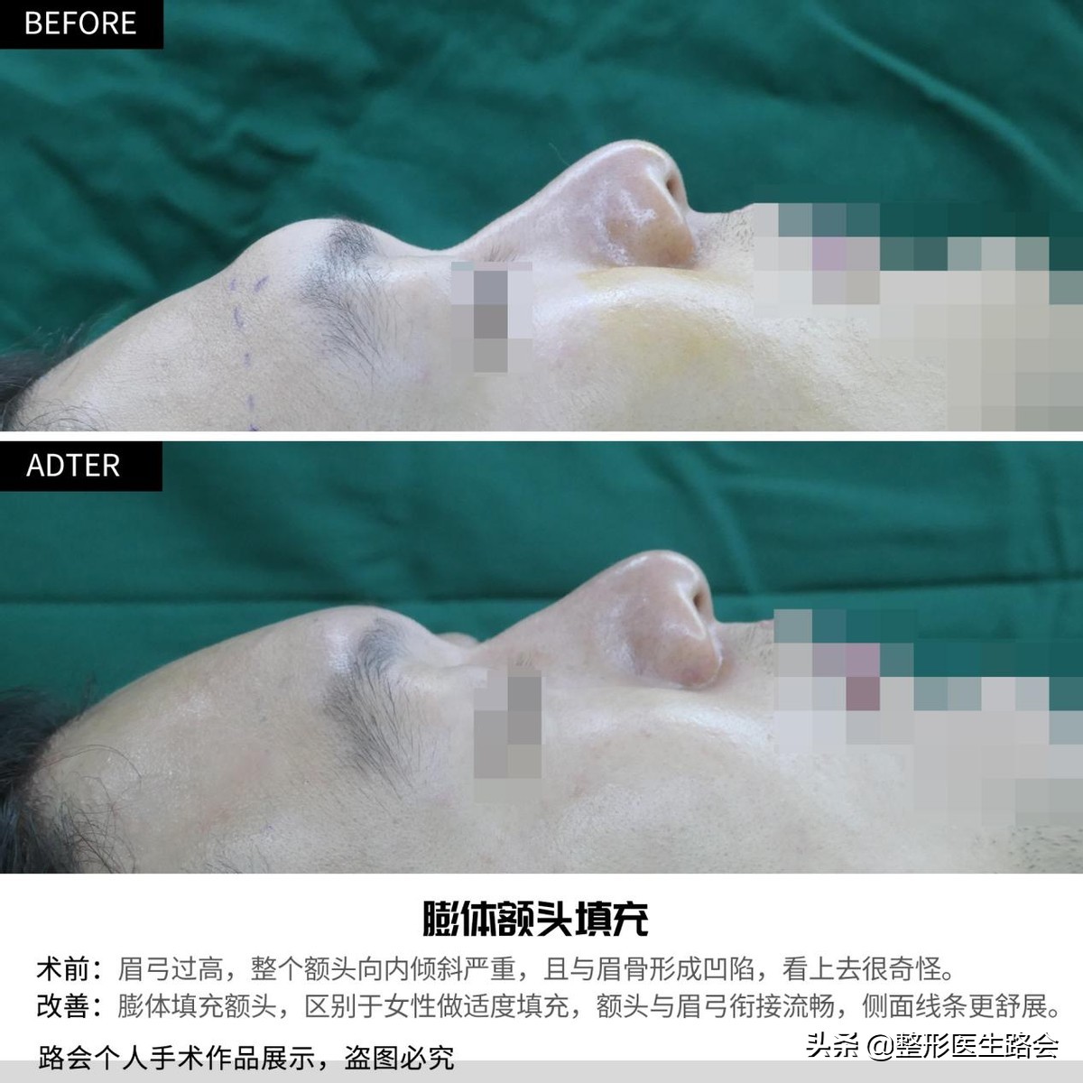 自体脂肪丰额头的危险,自体脂肪和膨体