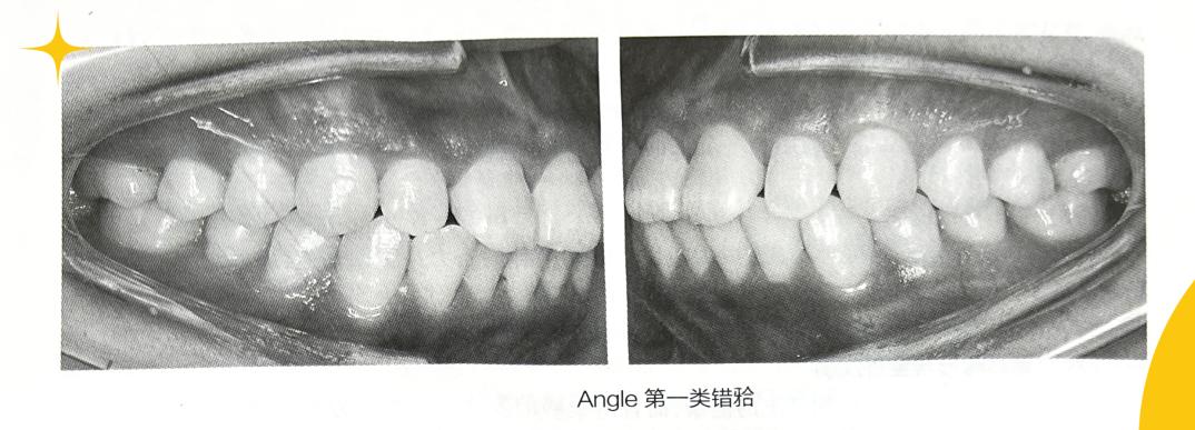 错颌畸形的分类方法,错颌畸形的检查诊断病例
