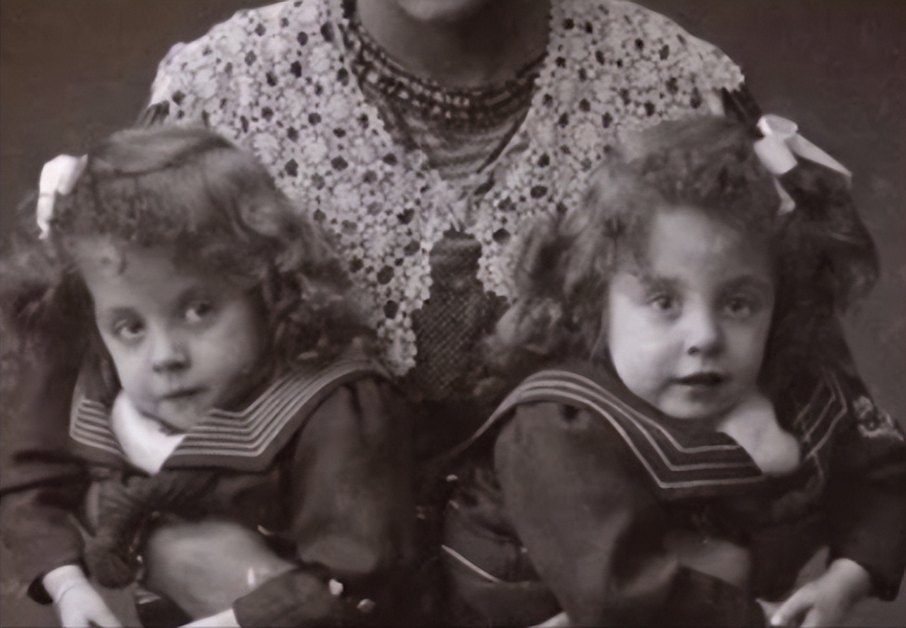 连体人一人去世了另一人会死吗,连体人死亡对另一半有影响吗