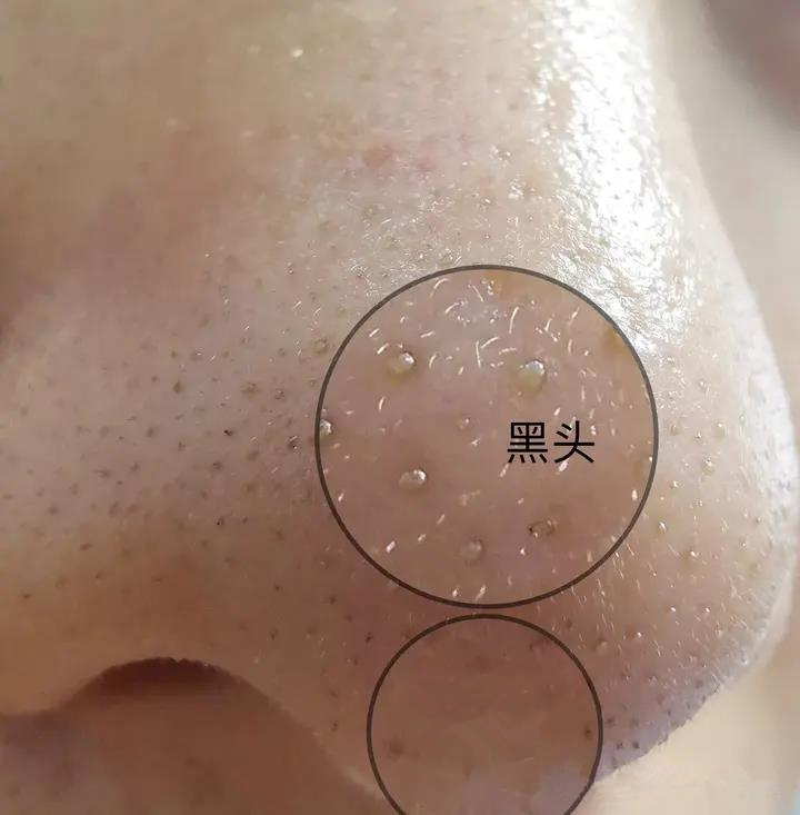 鼻子上好多黑头把毛孔堵住了,鼻子上的黑头怎么去除最有效方法
