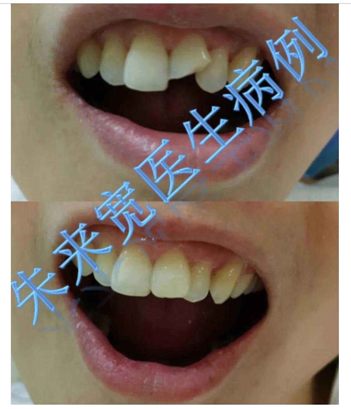 牙齿历险记（第12集）补牙材料