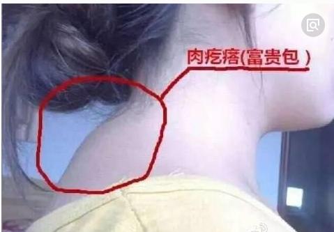 富贵包形成的原因及危害视频,儿童富贵包的形成与危害