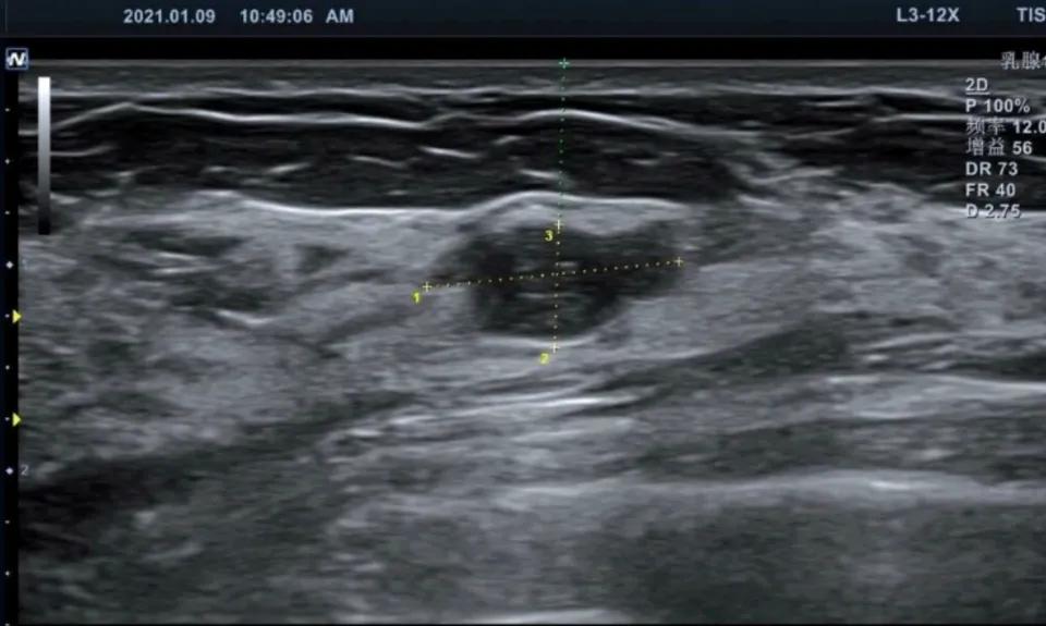 乳腺结节手术及恢复是全过程,乳腺结节微创手术治疗的过程