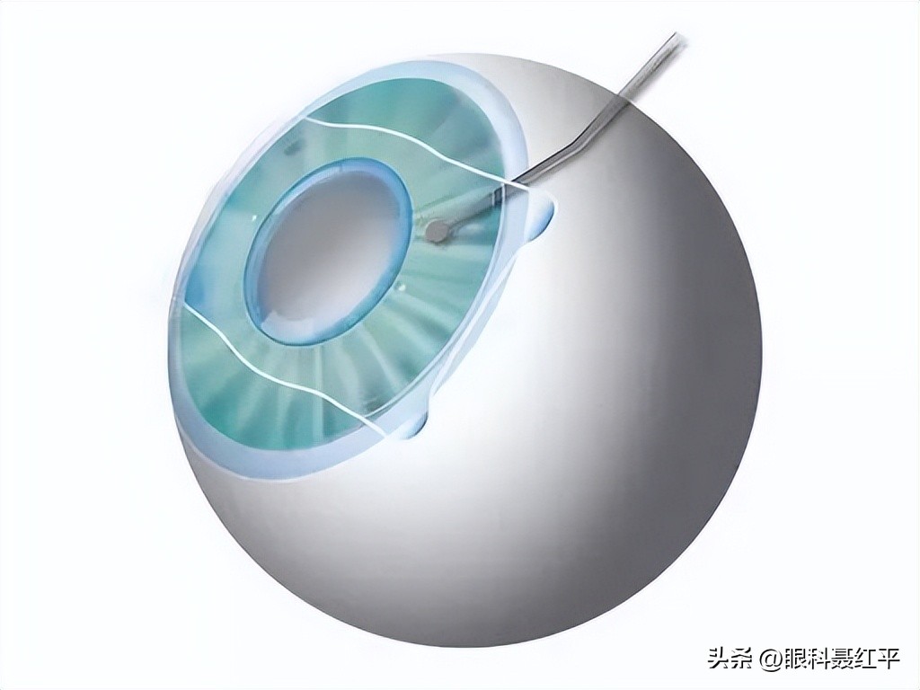 黄斑病变怎么预防,什么原因会导致黄斑病变