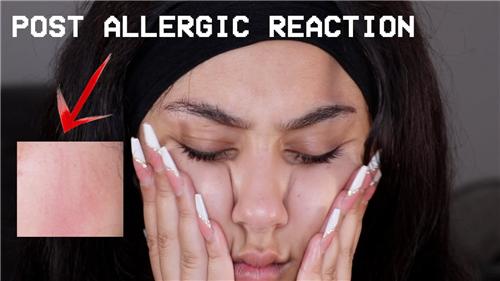 对水过敏的人怎么喝水,怎么会对水过敏