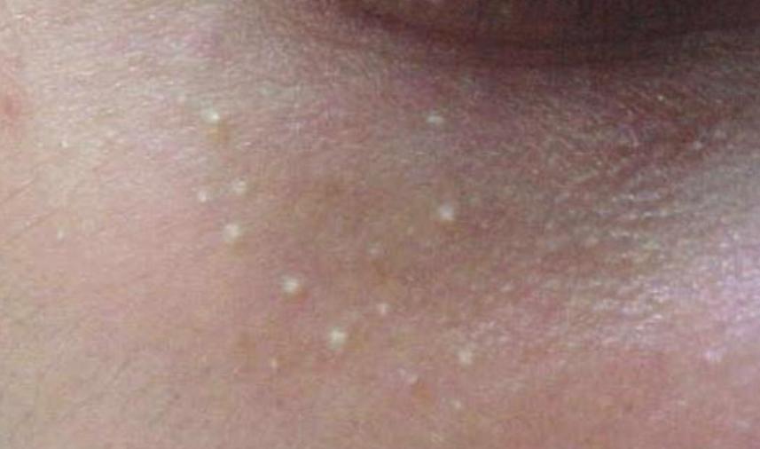 脖子和腋窝下的小肉粒怎么去除,脖子和腋下的小肉粒是啥