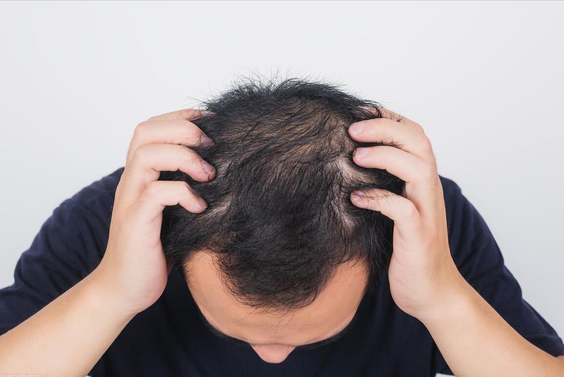 治疗脱发男女通用的药物,男女治疗脱发一样吗