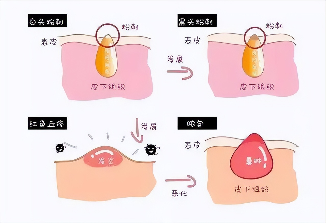 孕期祛痘能用哪些药膏,孕期长痘痘用什么面膜正确