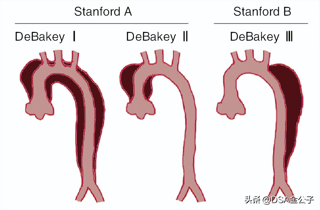 主动脉夹层动脉瘤的超声表现,主动脉夹层动脉瘤会左脚痛吗
