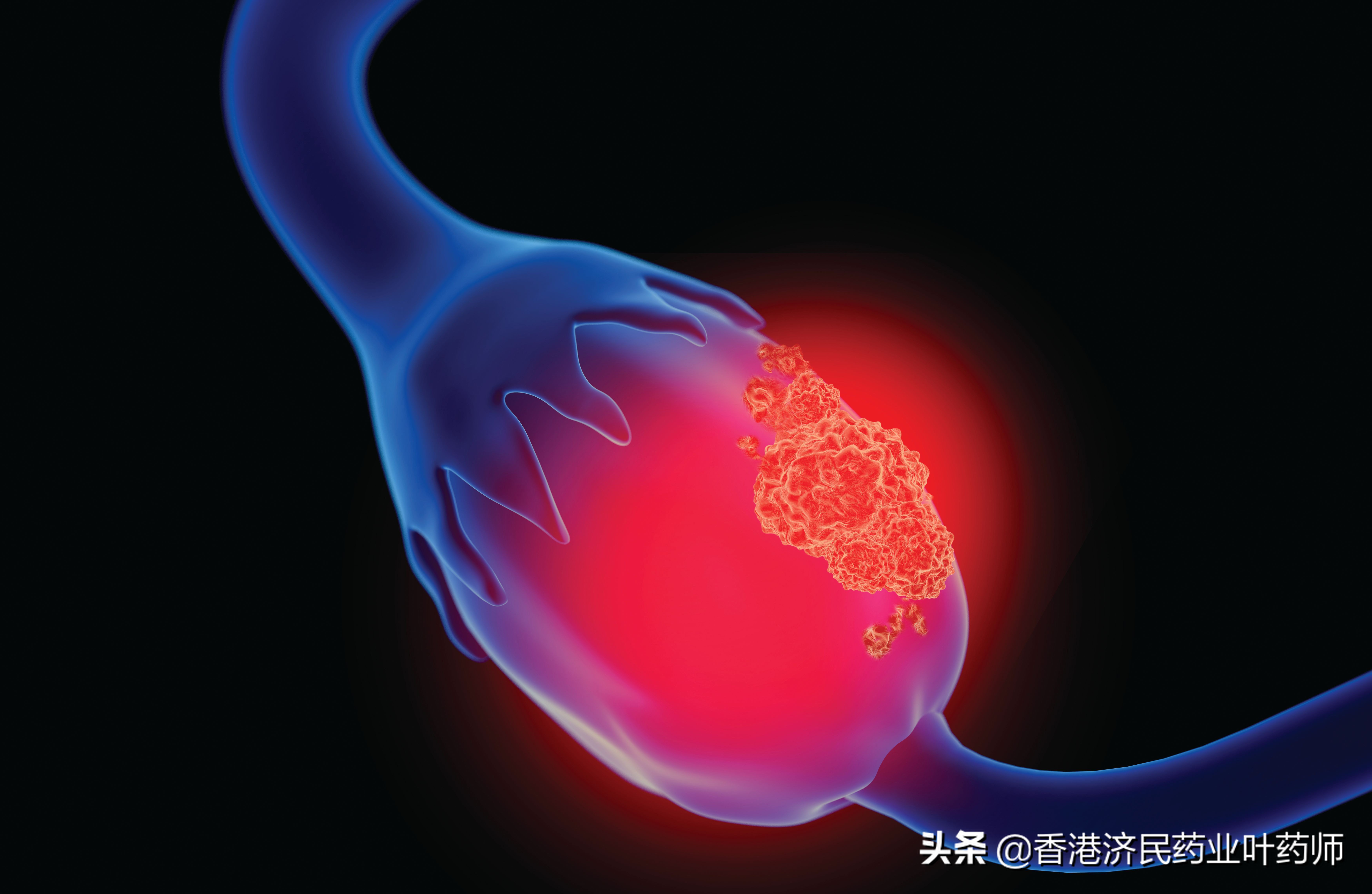 FDA批准CYTALUX,pafolacianine,用于在手术期间识别卵巢癌