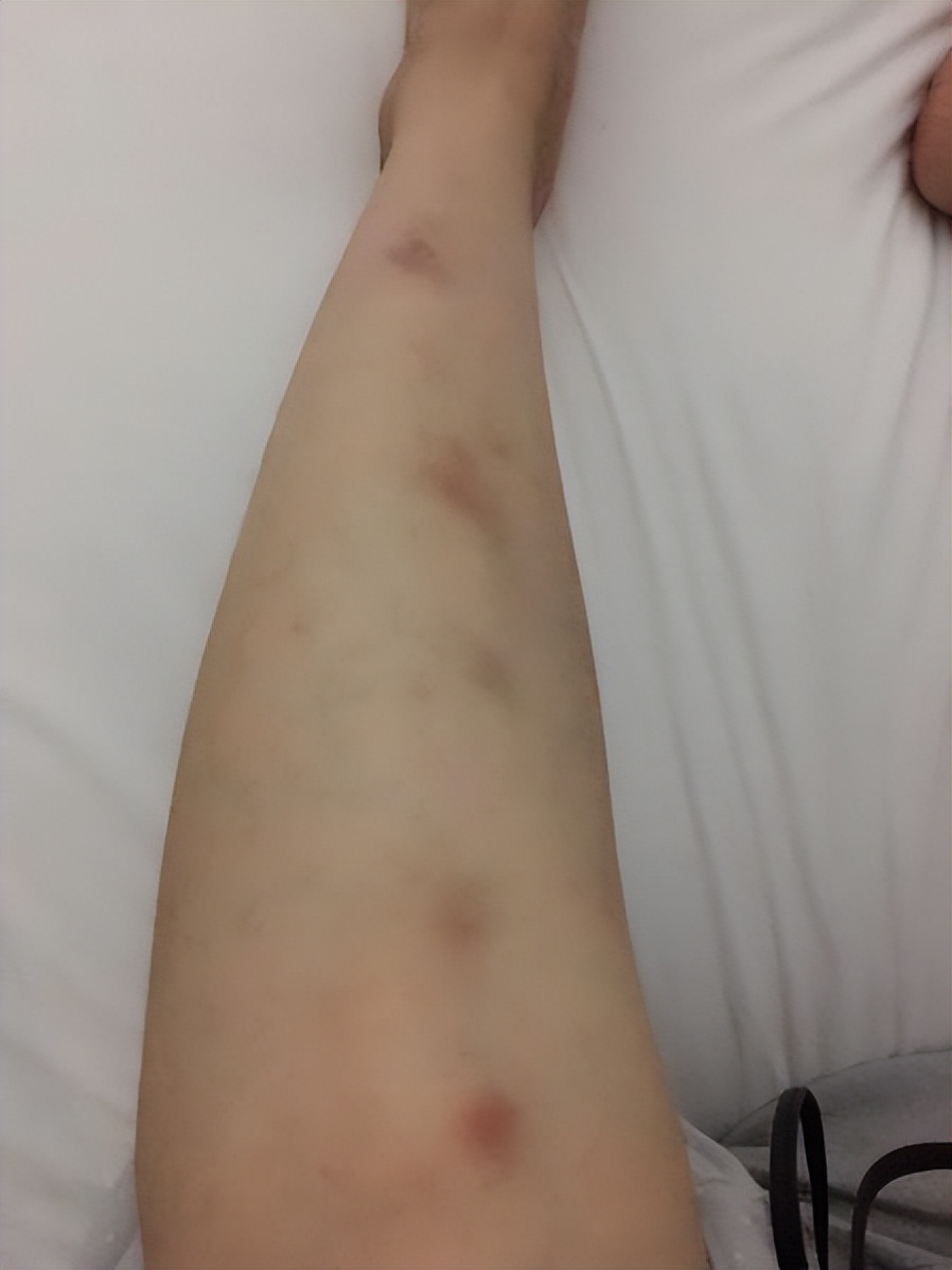 倪海厦治疗紫癜,紫癜如何治疗