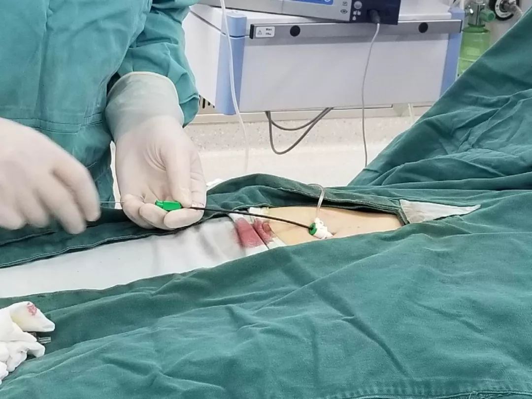 全胸腔镜下，与右侧开胸小切口房间隔缺损修补术的临床结果分析