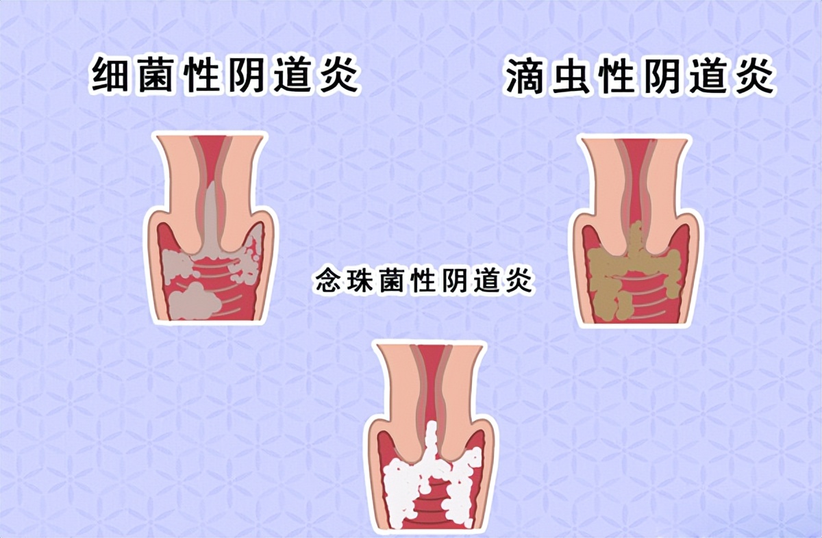 女子检查身体发现自己有两个子宫,女子查出有两个子宫