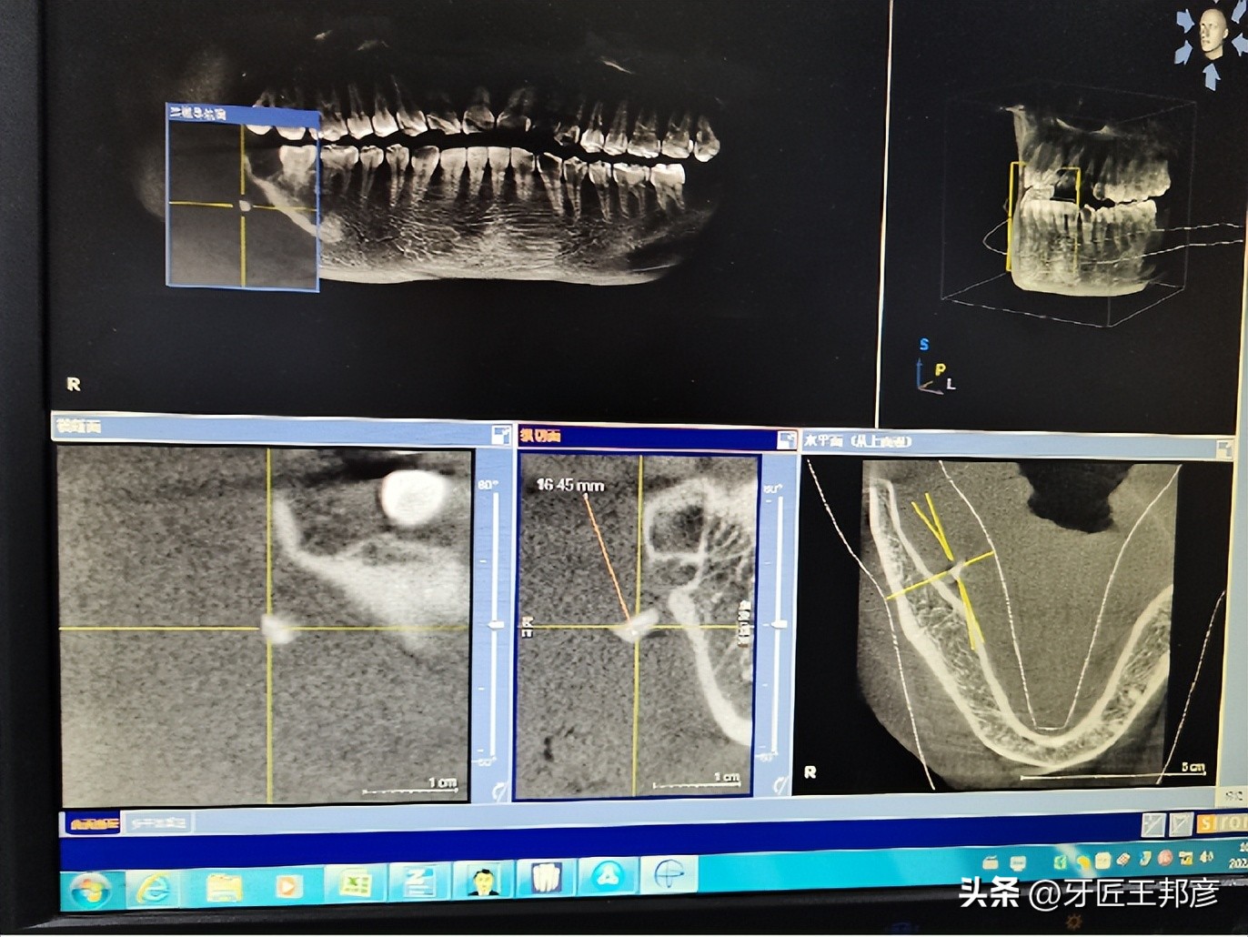 智齿牙根掉入间隙,智齿自己掉了牙根还在里面怎么办