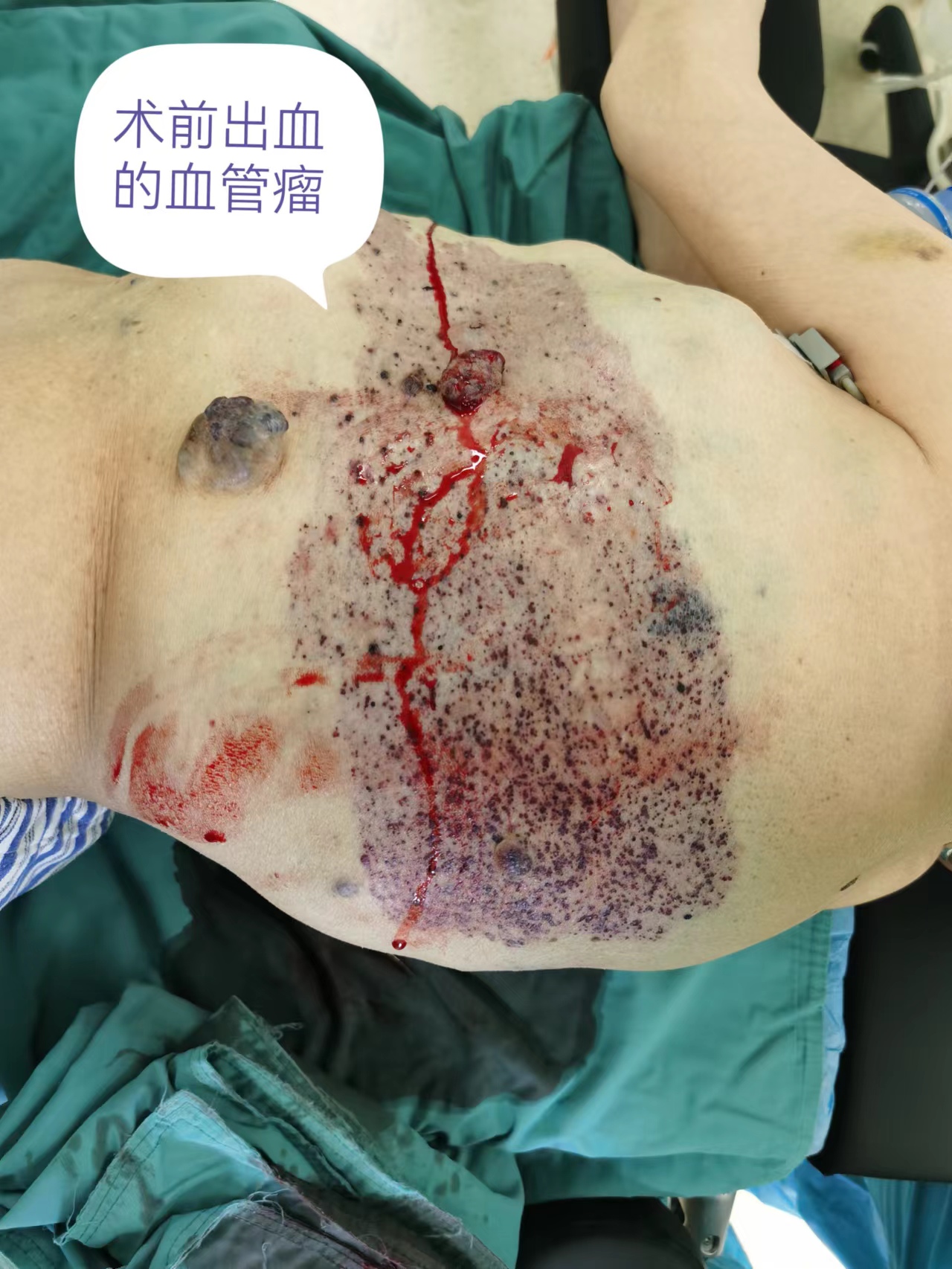 兰州二院血管瘤,兰州第二人民医院雁滩分院怎么样