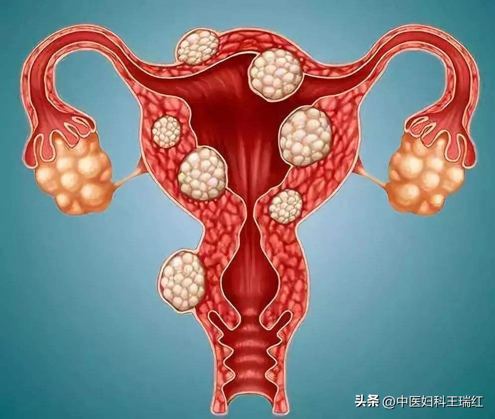 贫血严重有子宫肌瘤怎么治疗,贫血发现子宫内膜癌