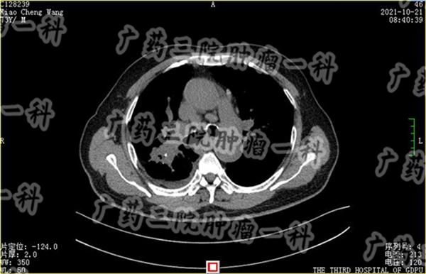 肺癌iva期怎么治疗,肺癌iva期值得治吗