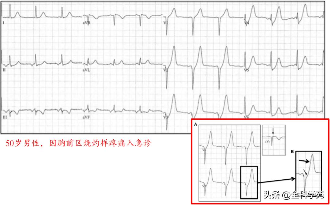 t波高尖心电图判断标准,t波高尖判断标准