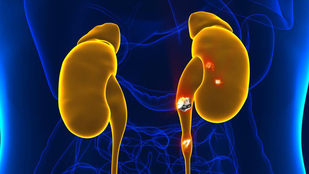 肾积水是会造成什么后果,肾积水能引起什么后果