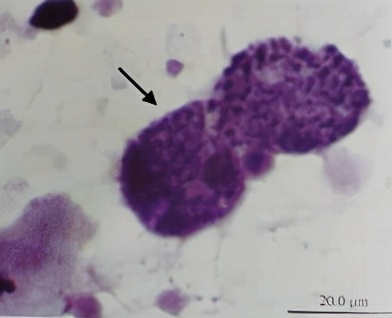 uu感染是什么意思,uu感染严重吗
