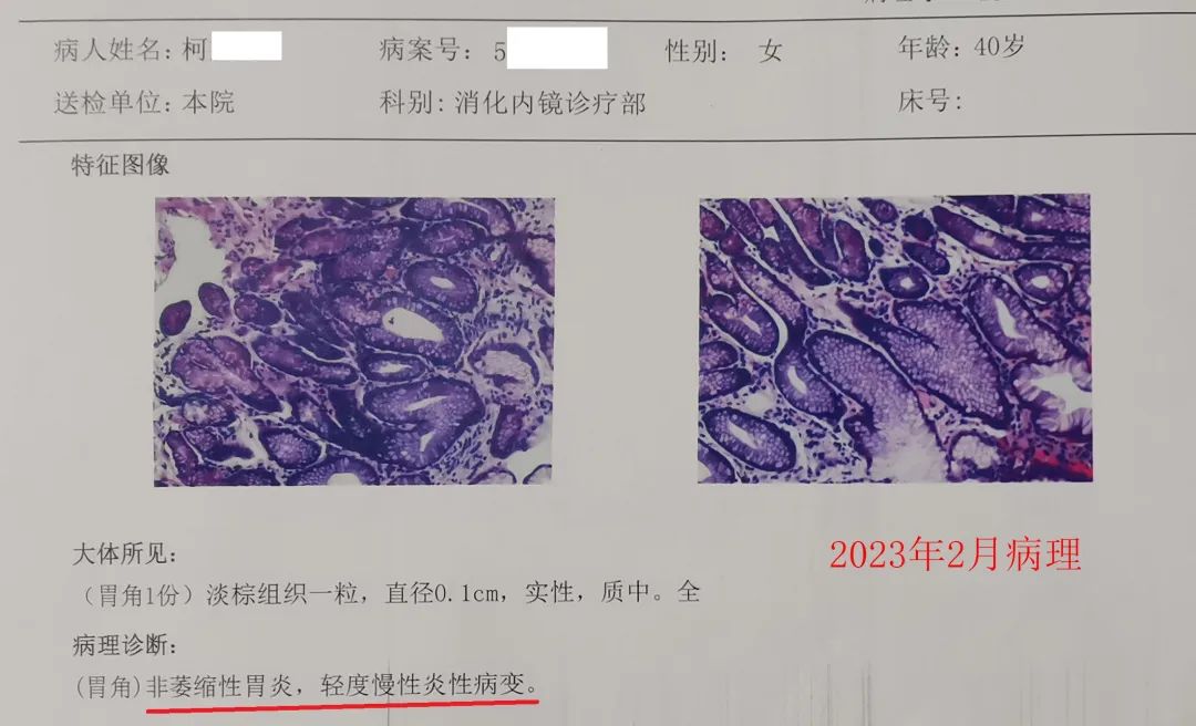 胃窦重度萎缩重度肠化多久会癌变,萎缩性胃炎重度肠化癌变几率