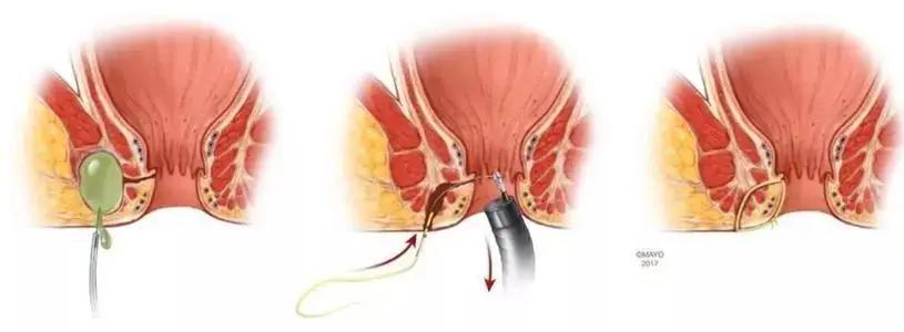 肛瘘手术没挂线是症状比较轻吗,肛瘘症状和痔疮症状有什么区别