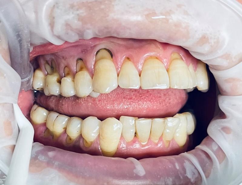 楔状缺损只有刷牙的时候会敏感,楔状缺损是横着刷牙造成的吗