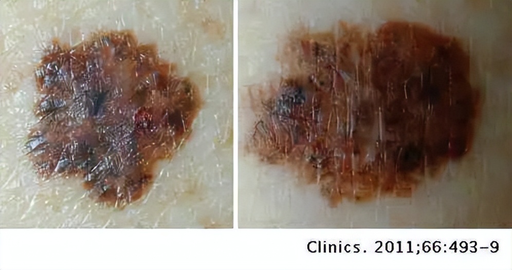 痣变黑变大是癌变了还是癌前病变,背上长了个肉痣是癌的象征吗