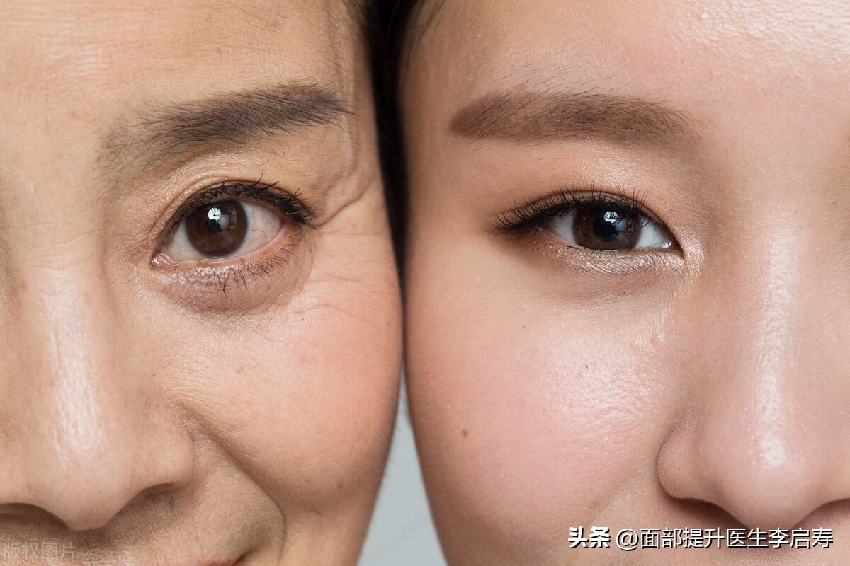 面部筋膜提升多久才是最佳效果,面部筋膜提升术5年后加速衰老