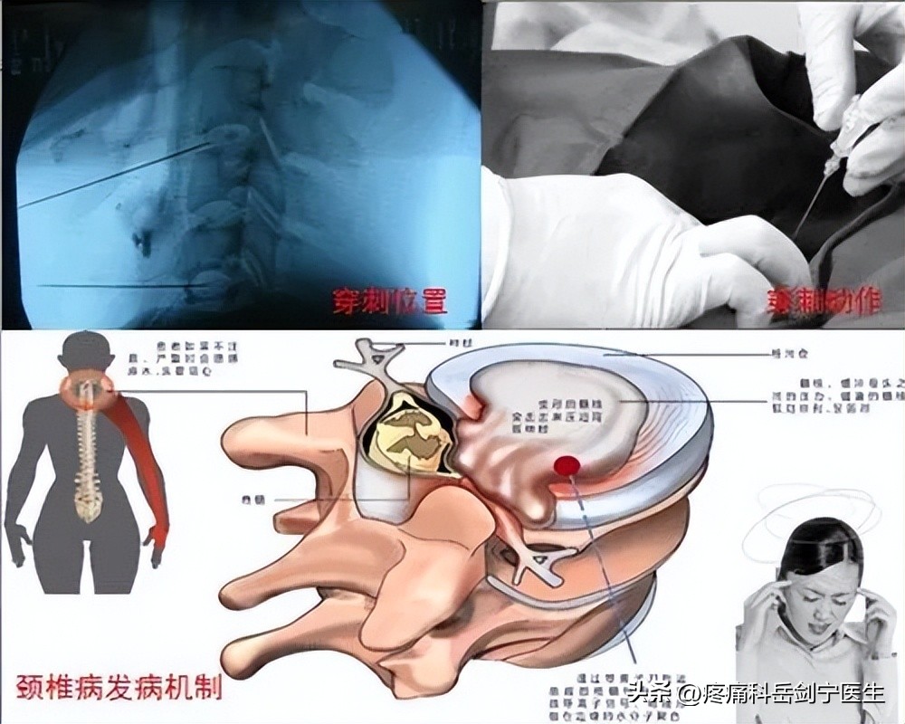 椎间盘突出微创介入疗法图片,椎间盘射频靶点消融术图解