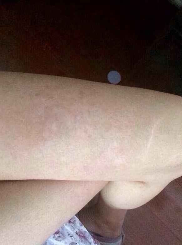 怎么消肥胖纹？吉首俪人教你