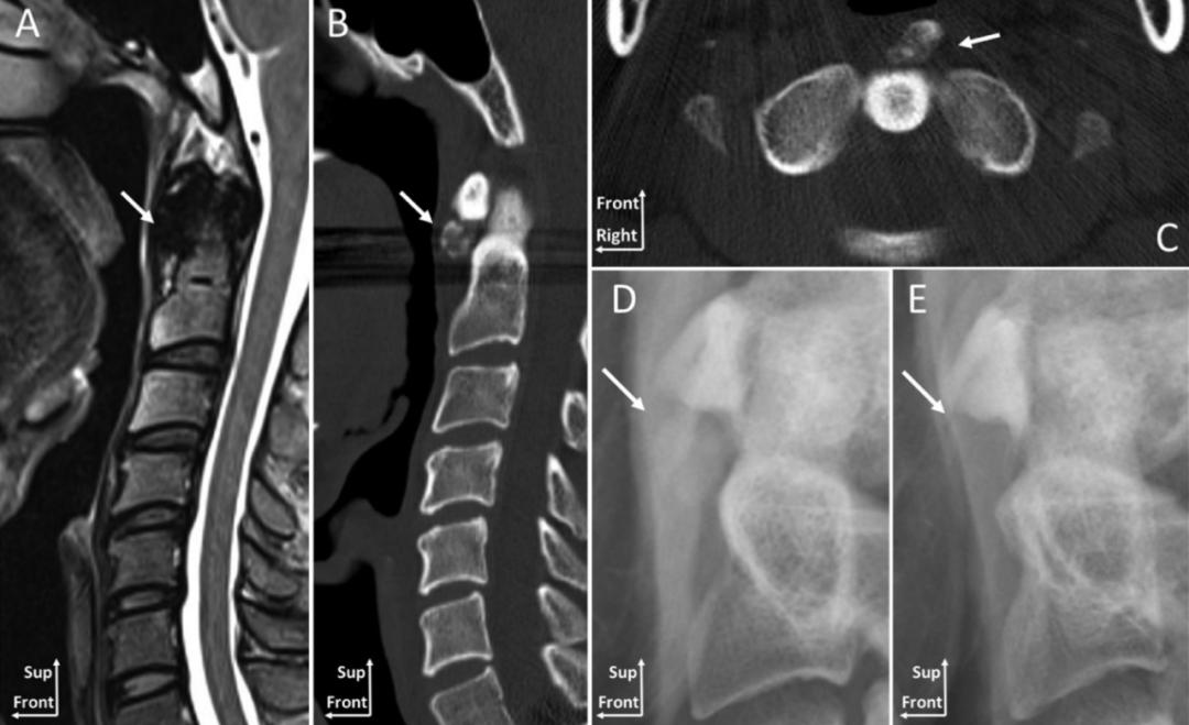 颈椎常见病变图片,颈椎严重的病例