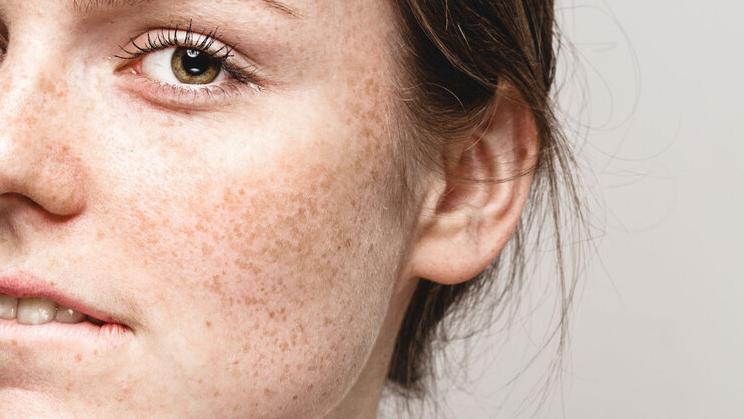 红霉素软膏能去除老年斑吗,红霉素软膏祛老年斑小妙招