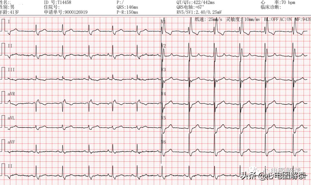 右束支阻滞qrs波形图解,右束支传导阻滞继发性st段改变