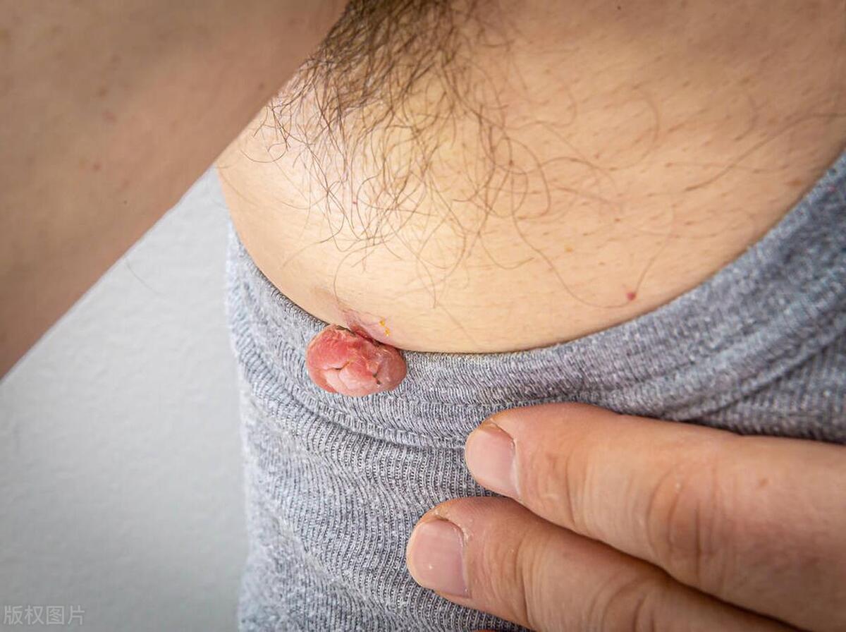 下面长的尖锐湿疣和假性湿疣到底怎么区分？医生教你几个方法辨别