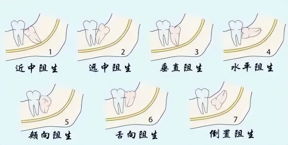智齿拔掉怎么处理坏牙,拔烂牙和智齿有区别吗