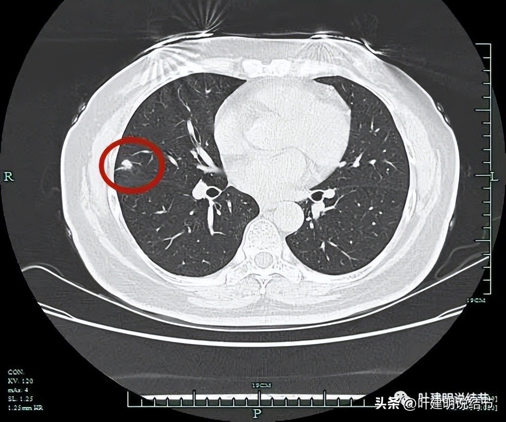 子宫内膜癌术后病灶大于二厘米,子宫内膜癌手术后一年又发现肺癌