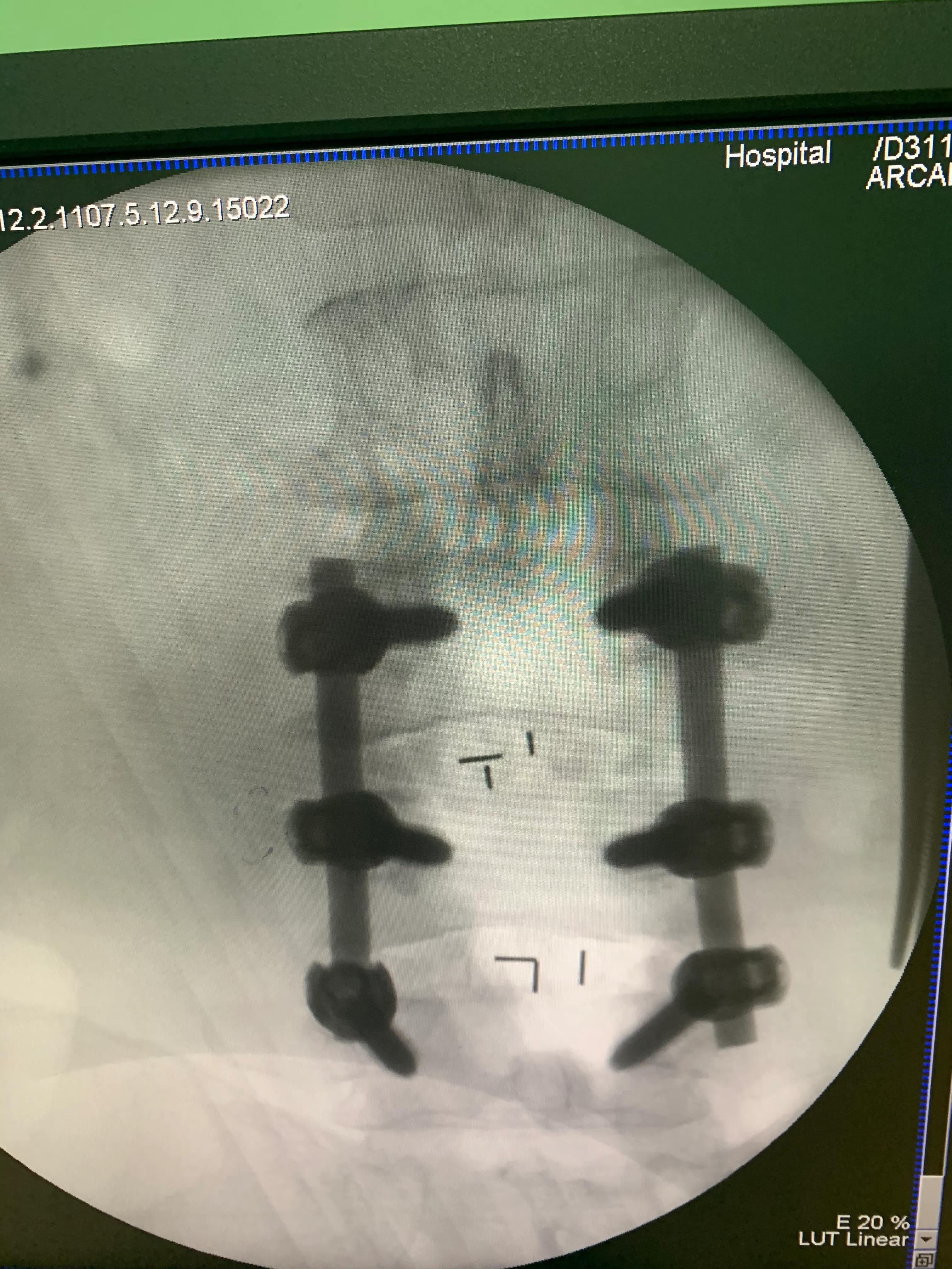 6块钱治疗腰椎间盘突出,腰椎间盘突出正确睡姿图