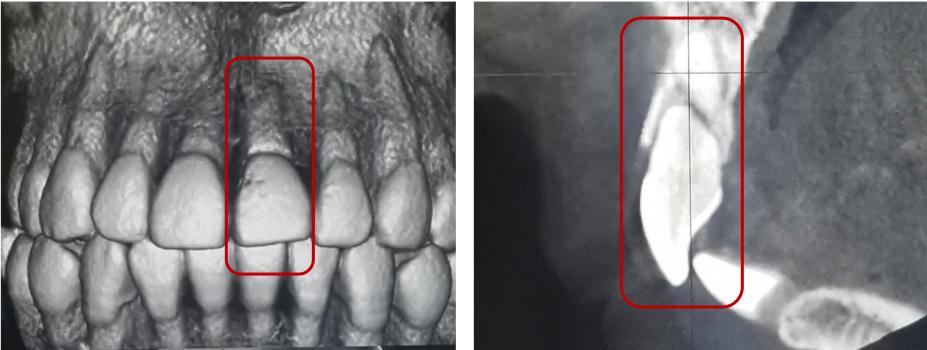 牙齿受外伤吃什么对牙好,牙齿受损伤引起牙痛怎么办